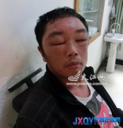 萍鄉(xiāng)一男子過節(jié)染發(fā) 染得腦袋腫大[圖]